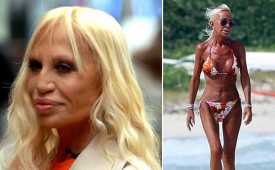 Donatella Versace after surgery