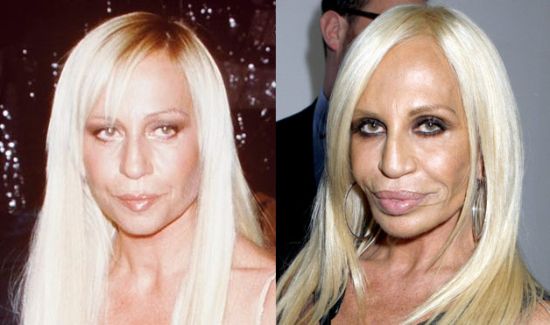 Donatella Versace plastic surgery gone wrong pic