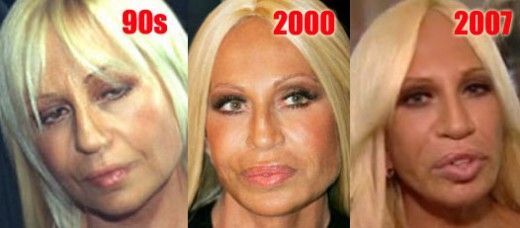 Donatella Versace plastic surgery photos