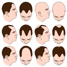 Receding Hairline Signs in Men