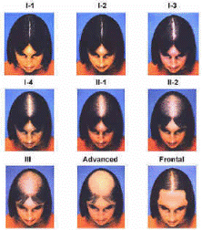 Receding hairline signs