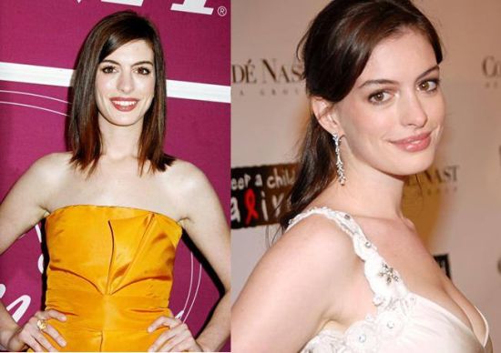 Anne Hathaway Plastic Surgery before and after