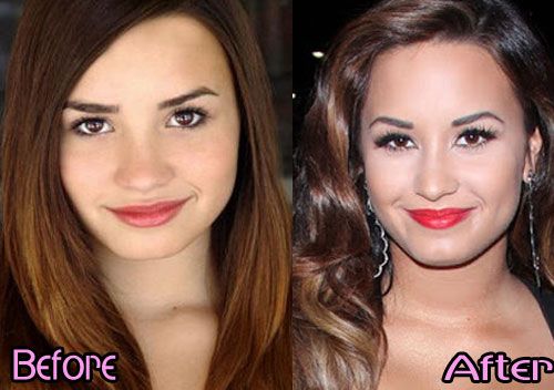 Demi Lovato Nose Job Before and After