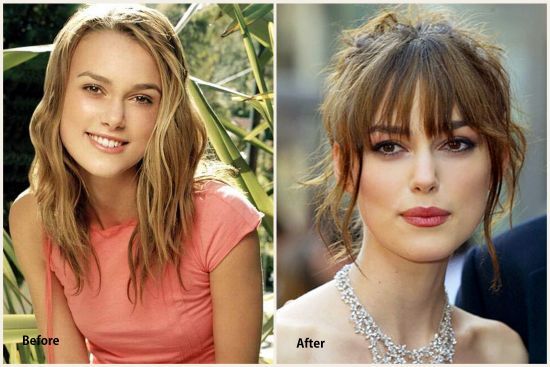 Keira Knightley plastic surgery before and after