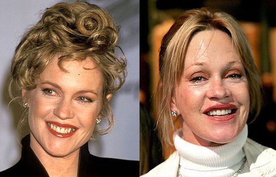 Melanie Griffith plastic surgery before and after