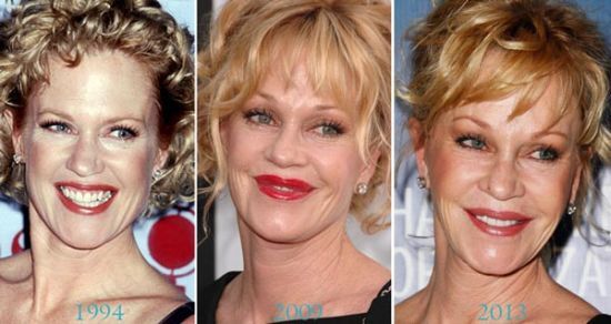 Melanie Griffith plastic surgery photos