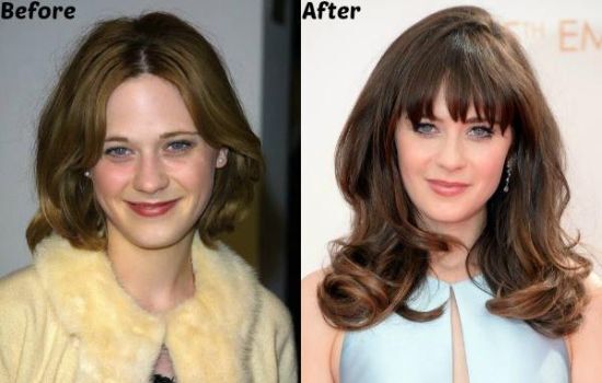 Zooey Deschanel plastic surgery