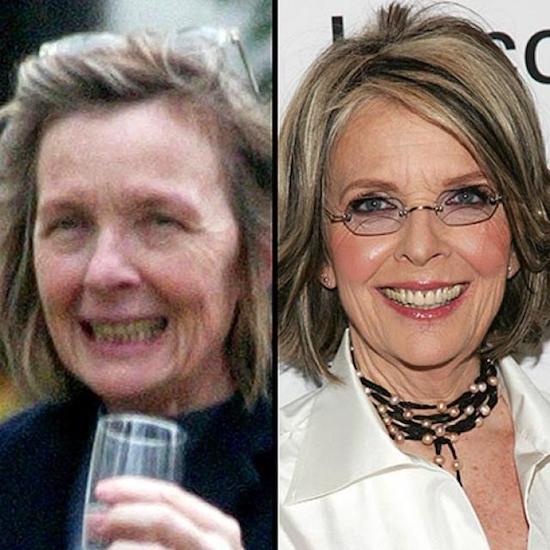 diane keaton plastic surgery before and after