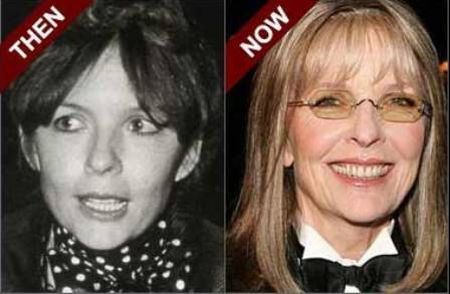 Diane Keaton plastic surgery