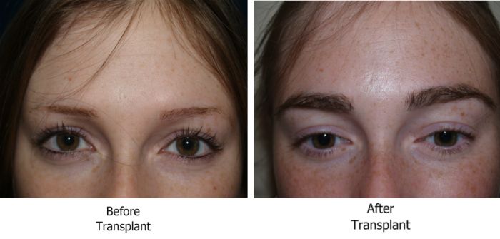 Eyebrow Restoration Surgery Before and After Photos