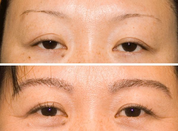 How Much Do Eyebrow Implants Cost: Before and after Photos