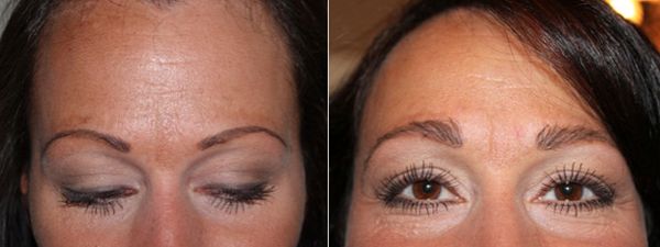 Eyebrow implants before and after photos