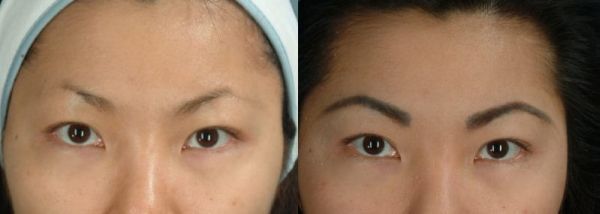 Eyebrow implants before and after