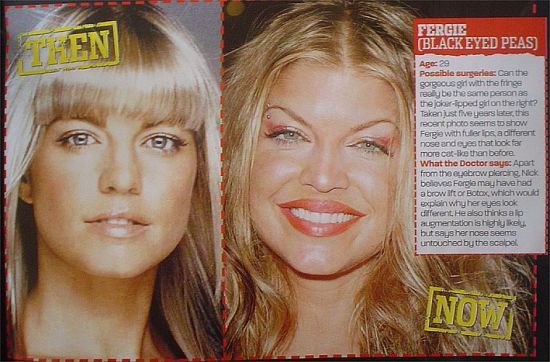 Fergie before plastic surgery and now