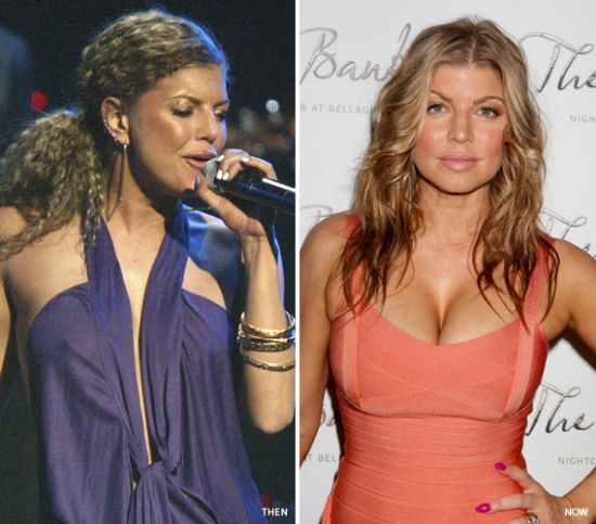 Fergie breast implants before and after