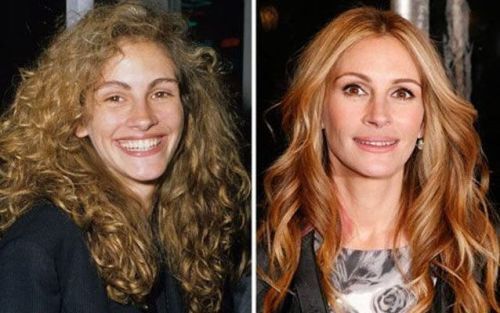 Julia Roberts Lip and Cheek Fillers