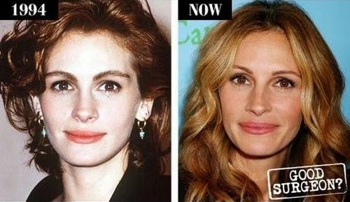 Julia Roberts plastic surgery before and after
