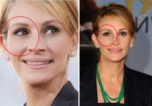 Julia Roberts plastic surgery photo