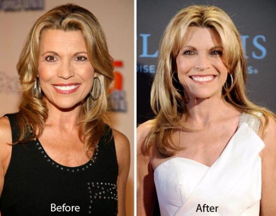 Vanna White plastic surgery before and after