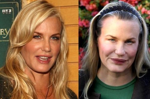 Plastic Surgery Gone Wrong: 26 Worst Celebrity Before And ...