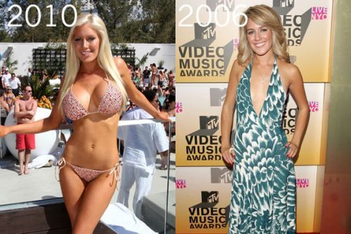 Heidi Montag plastic surgery gone wrong