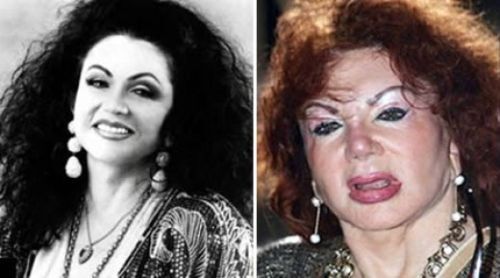 Jackie Stallone plastic surgery gone wrong