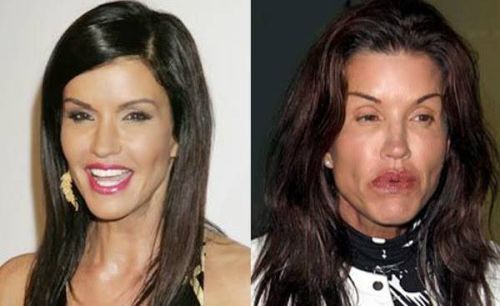 Janice Dickinson Plastic Surgery