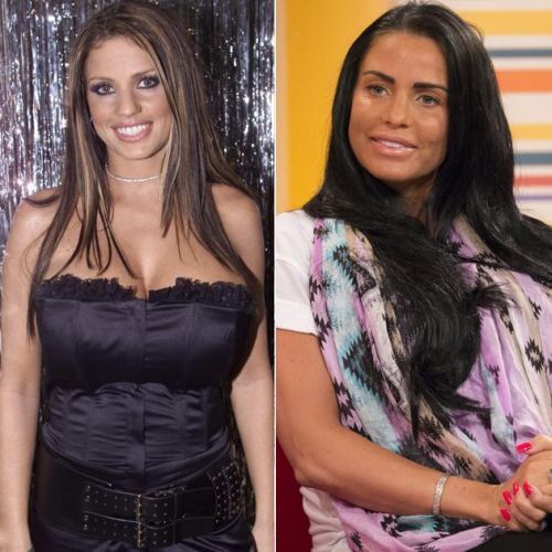 Katie Price before and after plastic surgery