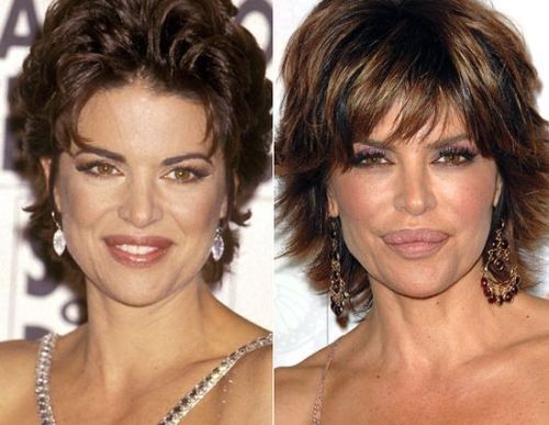 Lisa Rinna plastic surgery before and after