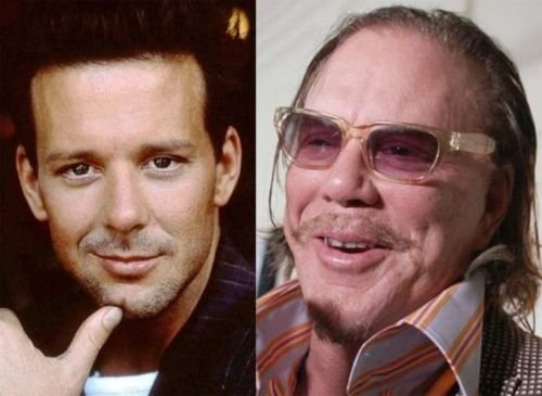 Mickey Rourke plastic surgery gone wrong
