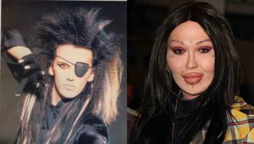 Pete Burns plastic surgery gone wrong