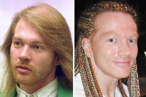 Axl Rose plastic surgery gone wrong