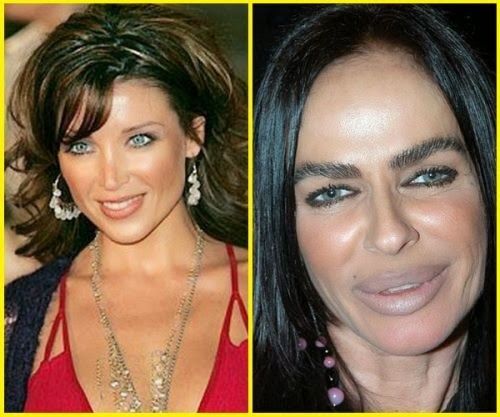 celebrities with bad plastic surgeryimage