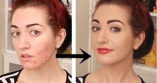How To Cover Up Acne & Scars With Makeup [Video & Tips]