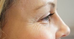 Wrinkles Under Eyes: How To Get Rid of It With Home Remedies