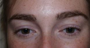 Eyebrow Restoration Surgery – Cost and Procedure