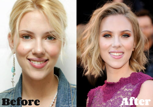 Scarlett Johansson Nose Job