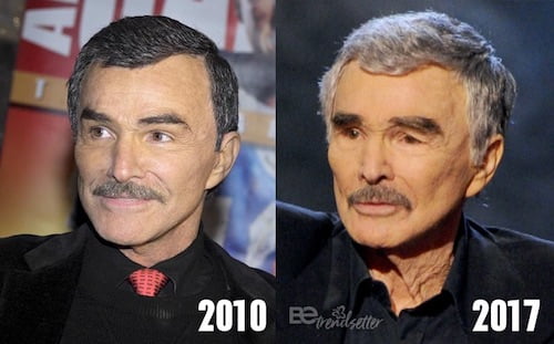 burt reynolds plastic surgery gone wrong