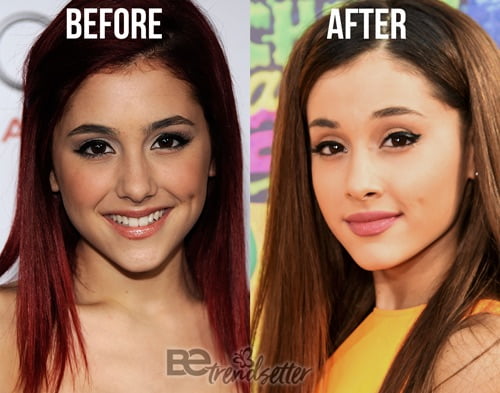 Ariana Grande Plastic Surgery REVEALED! Then And Now