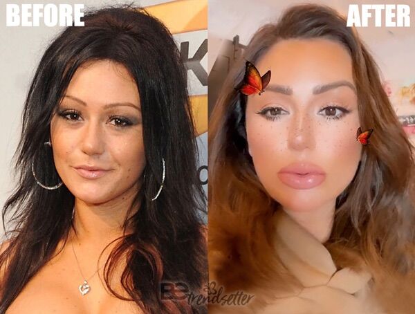 jwoww lip filler