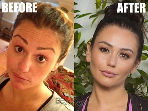 jwoww botox