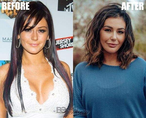 Jwoww plastic surgery