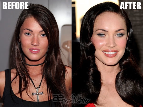 megan fox cheek filler before and after