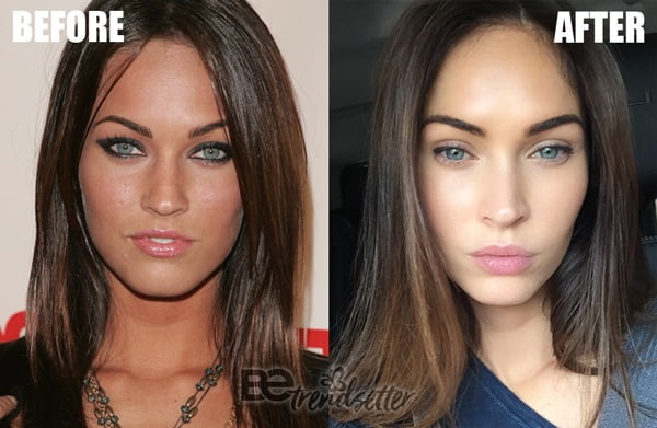 megan fox lip fillers