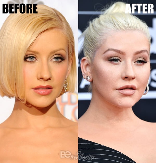 Christina Aguilera Botox