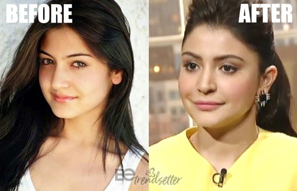 Anushka Sharma Lips Before and After