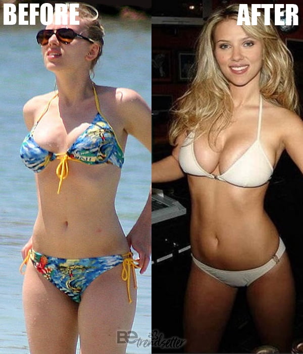 Scarlett Johansson breast implants.