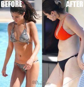 Selena Gomez Plastic Surgery Revealed! Before and After
