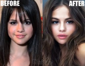 Selena Gomez Plastic Surgery Revealed! Before and After