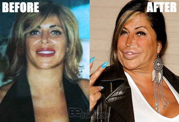 Big Ang, Angela Raiola Plastic Surgery Gone Wrong.